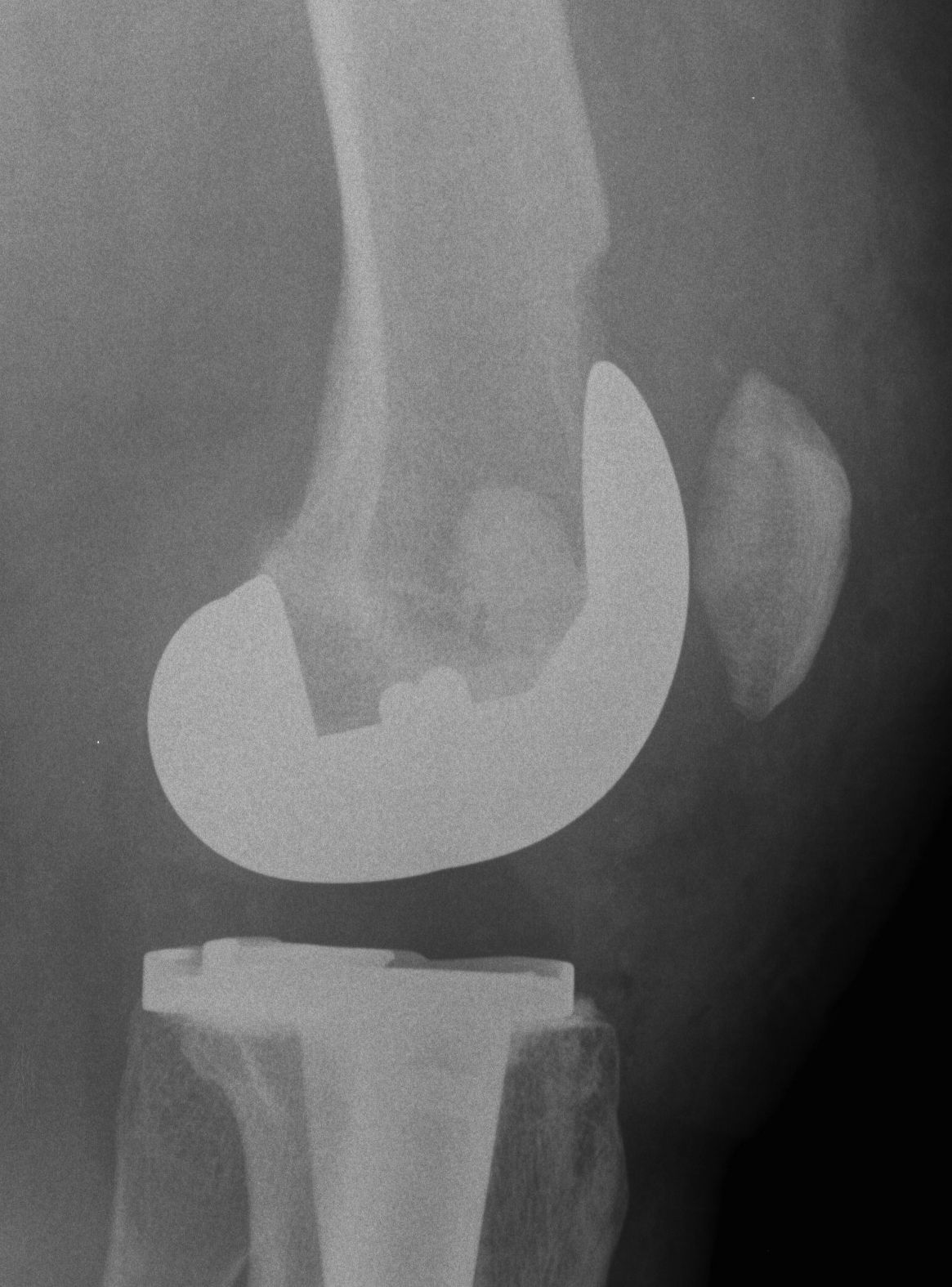 TKR Femoral Notching